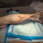 Watch for Infection! Importance of Wound Care for the Elderly